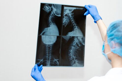 Osteocondrose Enfermidades da columna vertebral