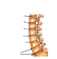 Etapas do desenvolvemento da osteocondrose