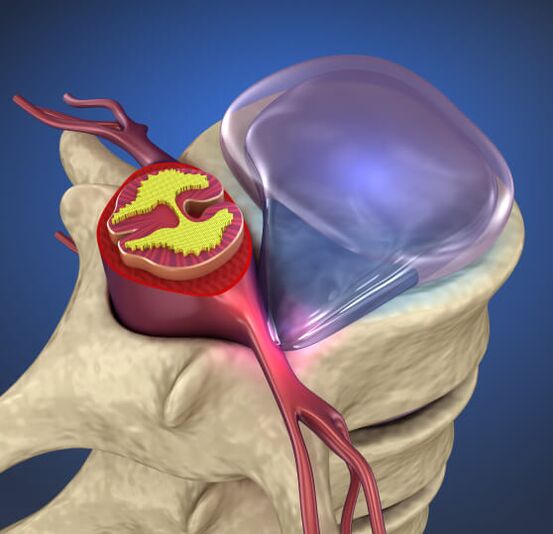Hernia intermedia