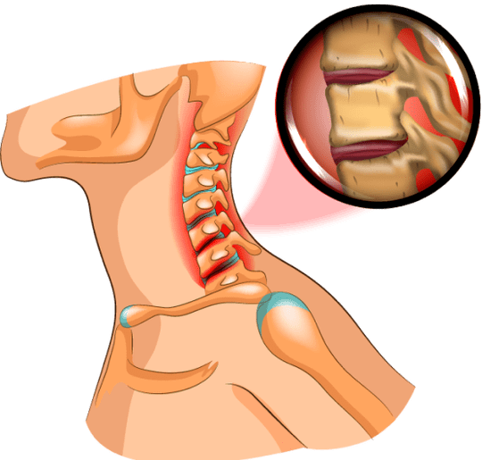 Osteocondrose no pescozo