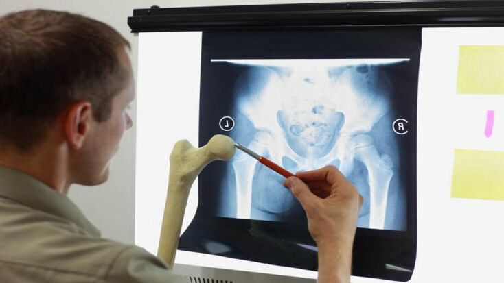 O médico examina unha radiografía para detectar a artrose da cadeira